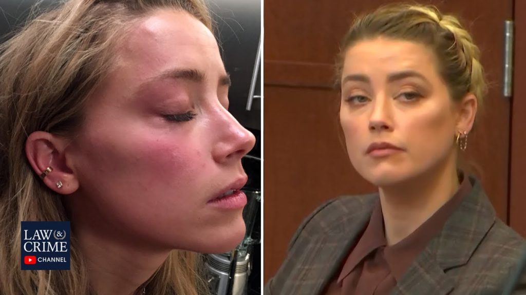 Did Amber Heard Get Botox Around The Time She Had Facial Injuries?